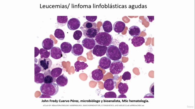 Aprende leucemia/linfoma linfoblástica aguda - Screenshot_01